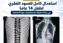التعليم العالي : استعدال كامل للعمود الفقري لطفل 14 عامًا بمستشفيات جامعة بنها