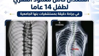 التعليم العالي : استعدال كامل للعمود الفقري لطفل 14 عامًا بمستشفيات جامعة بنها